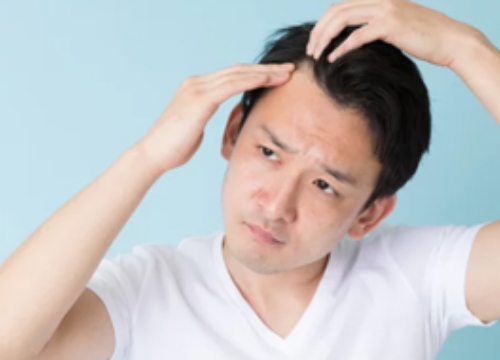 脱毛症（男性）