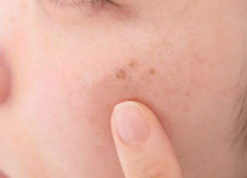 そばかす（ソバカス）