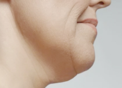 しわ（シワ）・たるみ